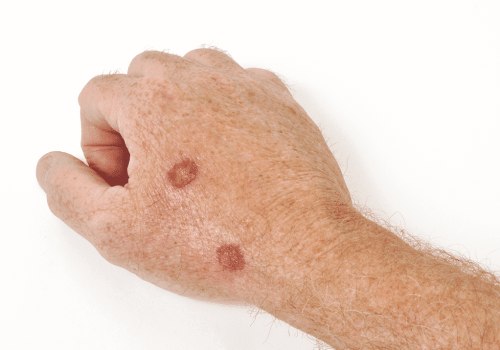 Stages of Wart Healing After Freezing: Speed Up Recovery Now