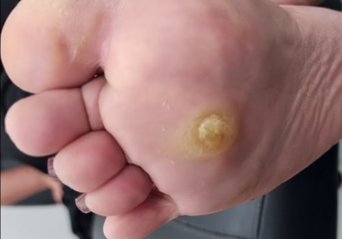 Podiatry Solutions for Effective Treatment and Removal of Intractable Plantar Keratosis
